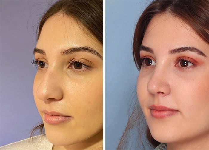 before & after photo of عملية تجميل الأنف