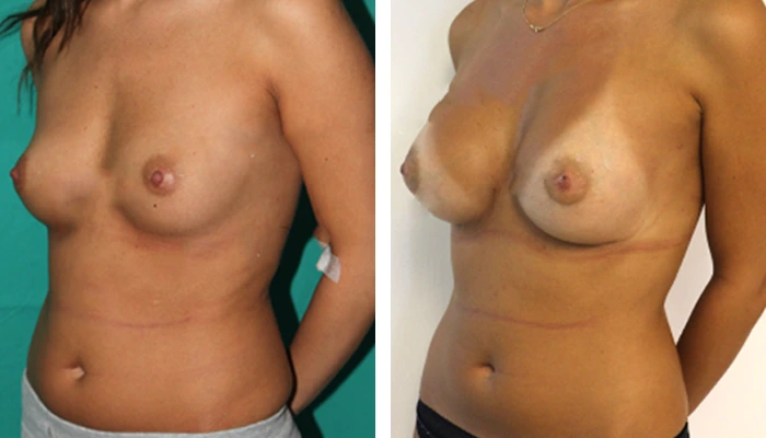 before & after photo of Breast Augmentation