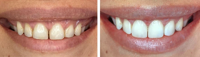 before & after photo of dental-bonding