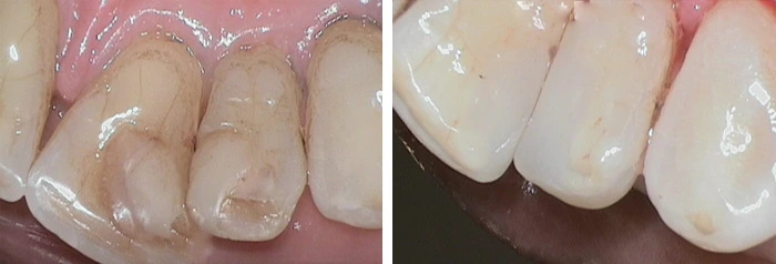 before & after photo of الربط السني