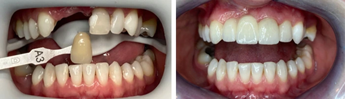 before & after photo of Dental Bridge