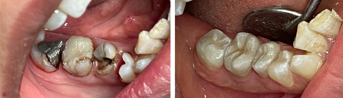 before & after photo of Dental Crown