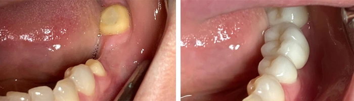 before & after photo of dental-crown