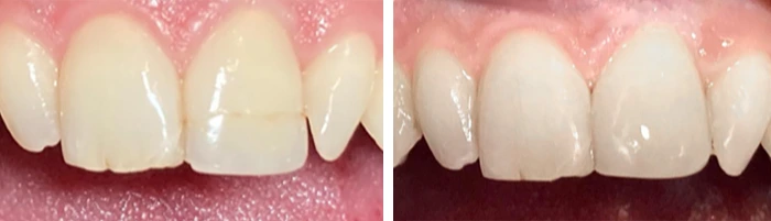 before & after photo of Dental Crown