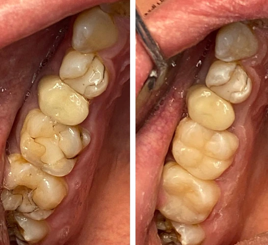 before & after photo of Dental Crown