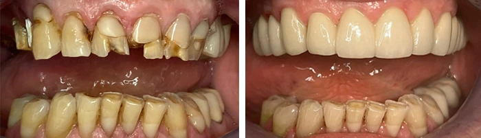 before & after photo of dental-crown