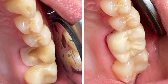 before & after photo of dental-crown