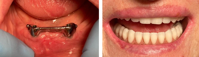 before & after photo of Dental Implant