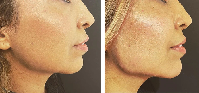 before & after photo of chin-jawline-filler