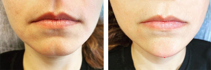 before & after photo of Chin and Jawline Filler