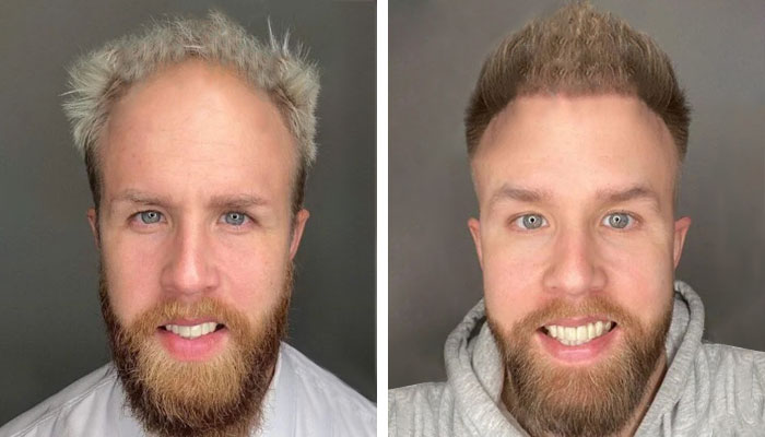 before & after photo of hair-transplant