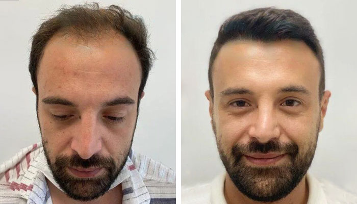 before & after photo of تخفيض خط الشعر (زراعة الشعر)
