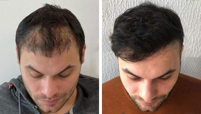 before & after photo of زراعة الشعر