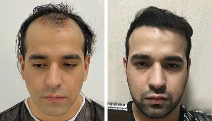 before & after photo of زراعة الشعر