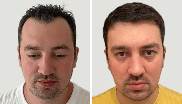 before & after photo of Hair Transplant