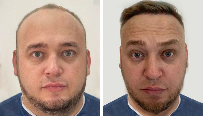 before & after photo of hair-transplant