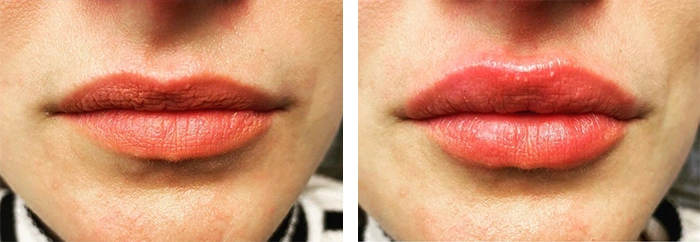 before & after photo of Chin and Jawline Filler