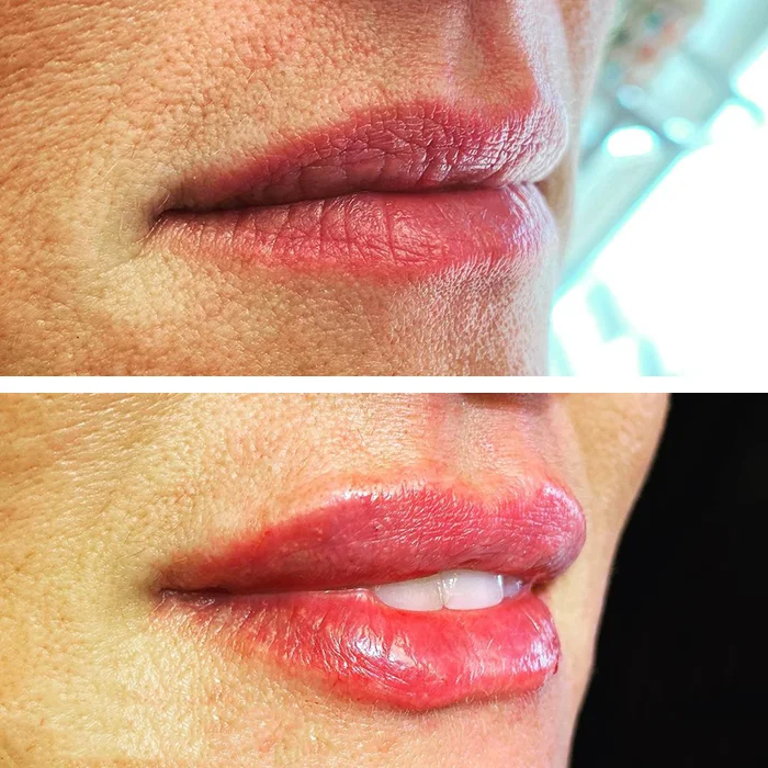 before & after photo of Chin and Jawline Filler