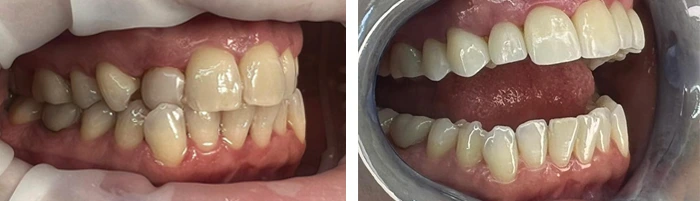 before & after photo of فينير الأسنان