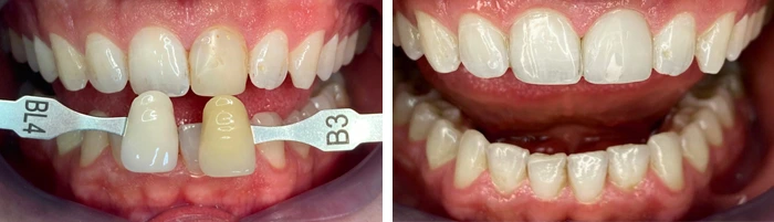 before & after photo of فينير الأسنان