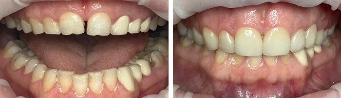 before & after photo of فينير الأسنان