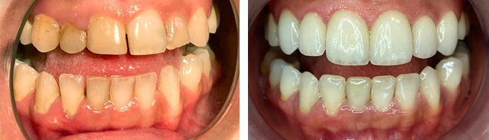 before & after photo of فينير الأسنان
