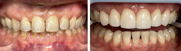 before & after photo of فينير الأسنان