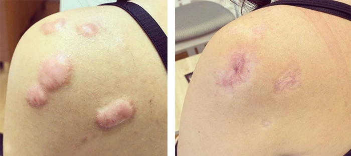 before & after photo of Scar Revision