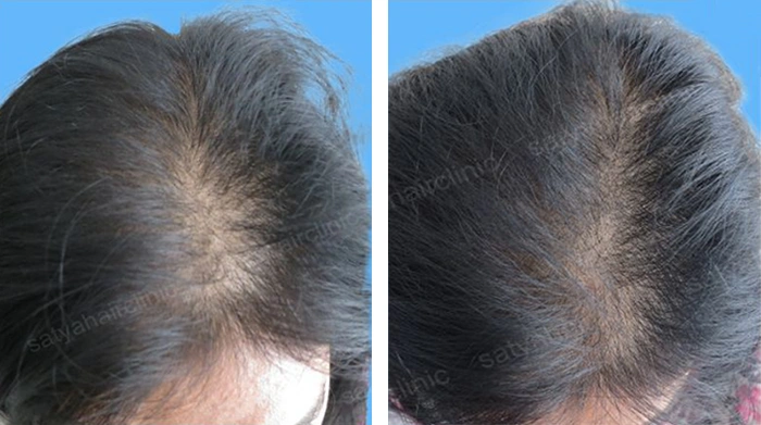 before & after photo of Artificial Hair Transplant