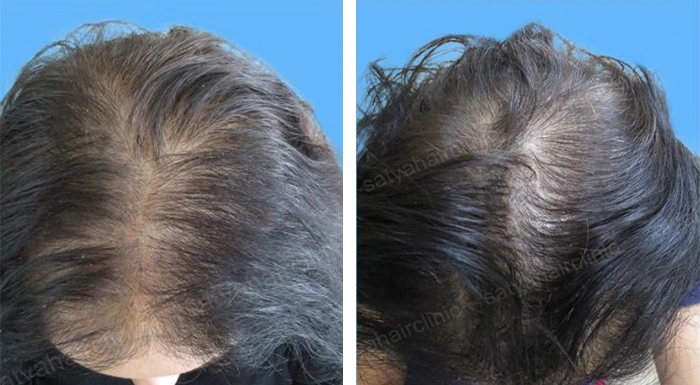 before & after photo of artificial-hair-transplant