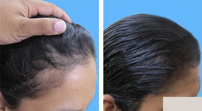 before & after photo of Artificial Hair Transplant