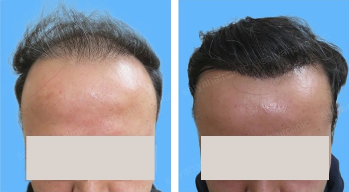 before & after photo of artificial-hair-transplant