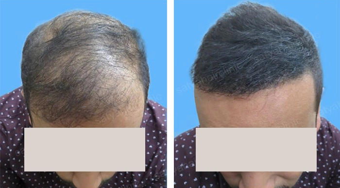 before & after photo of زراعة الشعر الاصطناعي
