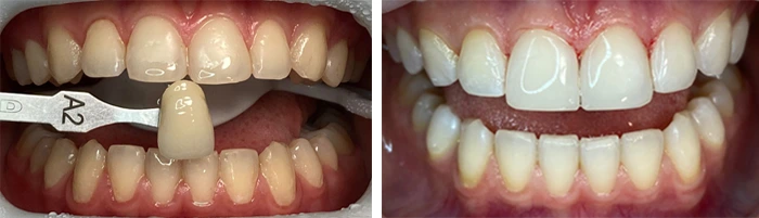 before & after photo of teeth-whitening