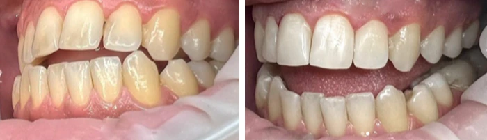 before & after photo of teeth-whitening