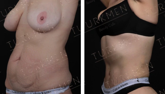 before & after photo of Abdominal Etching