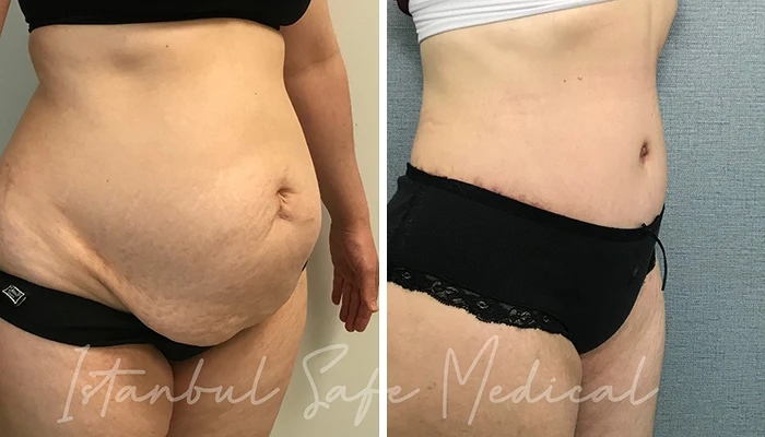 before & after photo of Abdominal Etching