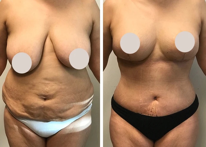 before & after photo of Abdominal Etching