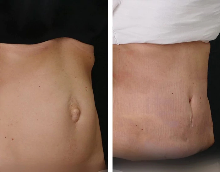 before & after photo of Abdominal Etching