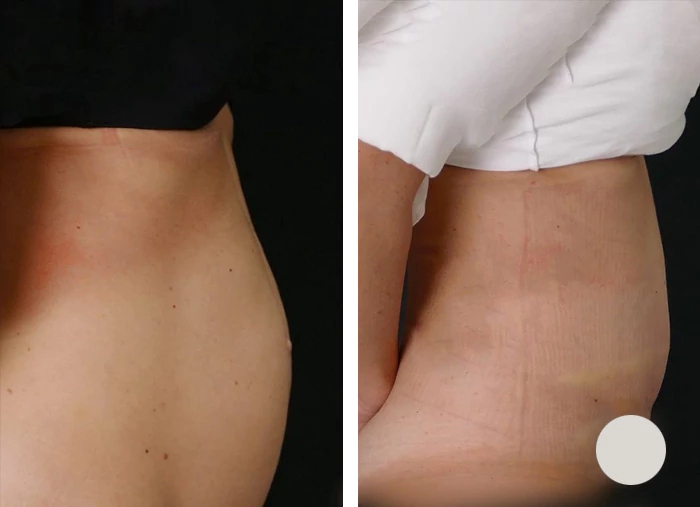 before & after photo of Abdominal Etching