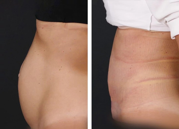 before & after photo of Abdominal Etching