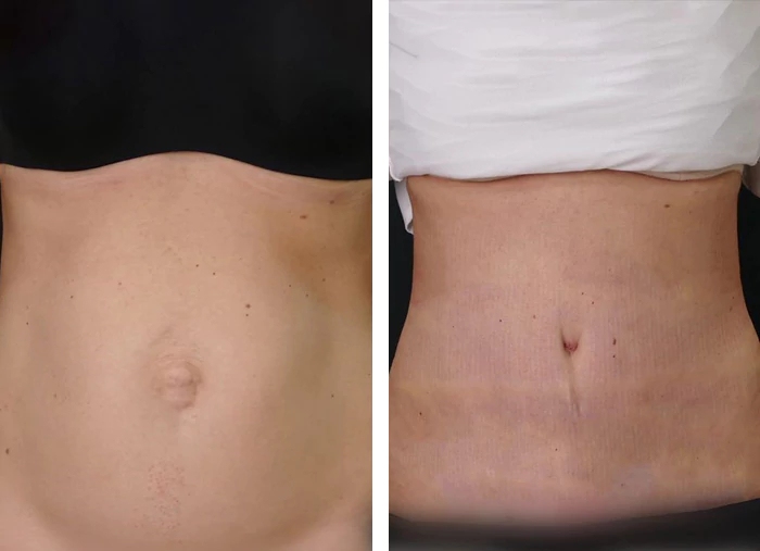 before & after photo of Abdominal Etching