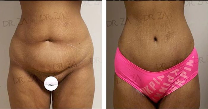 before & after photo of abdominal-etching