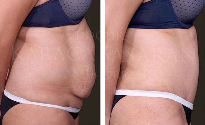 before & after photo of Abdominal Etching