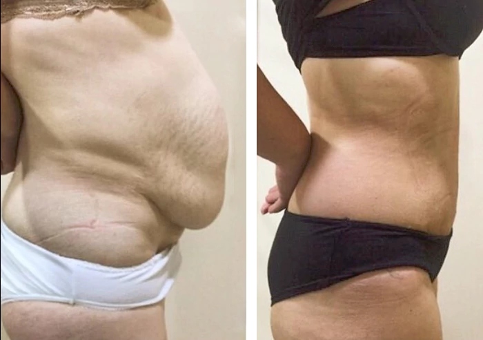 before & after photo of Abdominal Etching