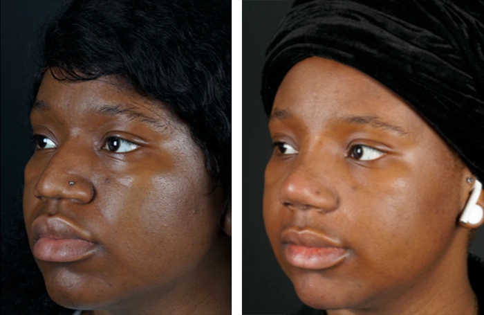 before & after photo of عملية تجميل الأنف