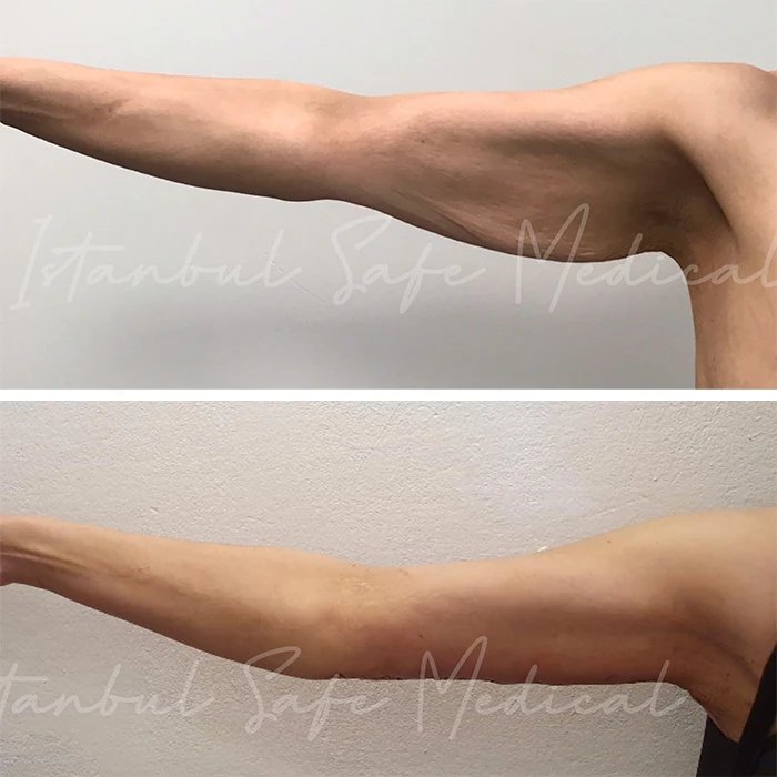 before & after photo of Arm Lift