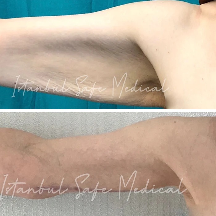 before & after photo of Arm Lift