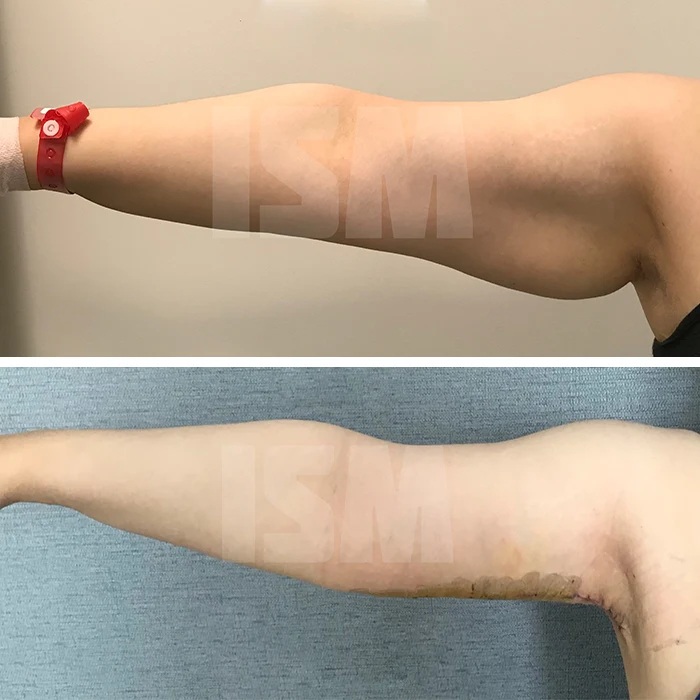 before & after photo of Arm Lift