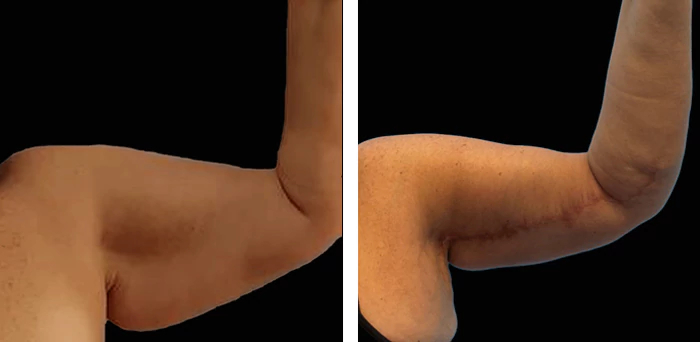 before & after photo of Arm Lift